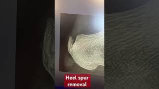 Heel spur removal post op visit