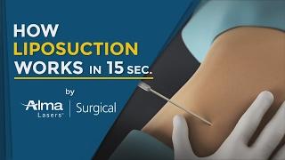 How Liposuction Works in 15 Seconds Medical Technology 3D Animation 2020