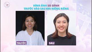 Niềng Răng Xong Trẻ Ra 10 Tuổi Bạn Có Tin ? Hành Trình Niềng Răng Cùng Sea Dental