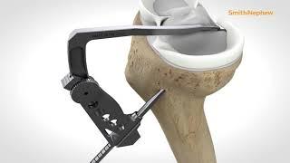 Meniscal Root Repair One-Tunnel Technique with FIRSTPASS MINI 14926-2 V3