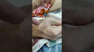 Removing accupuncture needles. #video #shorts #accupuncture #therapy