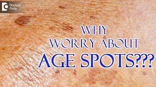 What are age spots? Can you get rid of age spots? - Dr. Nischal K