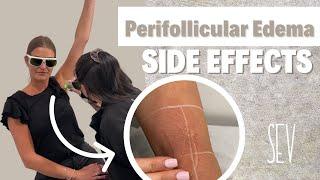 Perifollicular Edema Common Laser Hair Removal Side Effect