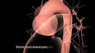 Aortic Disease Aortic Aneurysm and Dissection