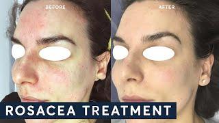 Treating Rosacea with IPL