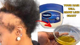 THIS HAIR GROWTH RECIPE with VASELINE will GROW your hair 2x faster no matter WHAT May 15 2024
