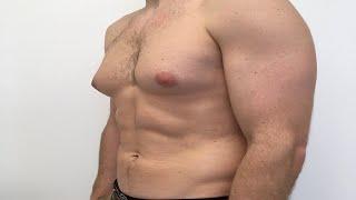 how to get rid of gynecomastia fast without surgery