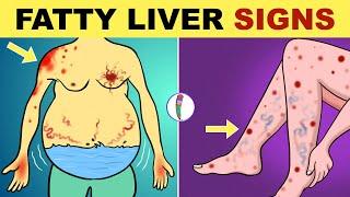 Fatty Liver Symptoms  Early Signs of Fatty Liver Disease  Non Alcoholic Fatty Liver Disease