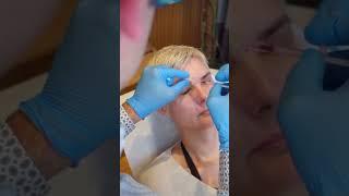 Botox Enjeksiyonu ile Daha Genç Daha Taze Bir Cilt Mümkün #gürayyeşiladalı #medikalestetik