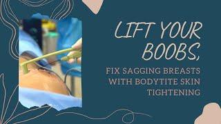 LIFT YOUR BOOBS  FIX SAGGING BREASTS WITH BODYTITE SKIN TIGHTENING  West Hollywood Dr. Jason Emer