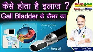 कैसे होता है इलाज GALL BLADDER  के कैंसर का  GALL BLADDER CANCER TREATMENT