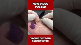 SUPER DEEP Corn Removal #shortsvideo #nails #cornremoval