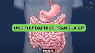 Ung thư đại trực tràng là gì? 6 dấu hiệu Chứng tỏ mắc bệnh ung thư đại tràng