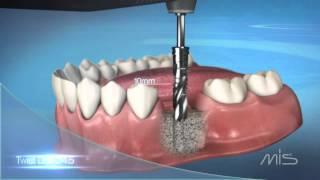 MIS M4 Implant Procedure Video