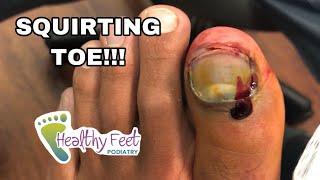 SQUIRTING TOE ENTIRE NAIL REMOVED WITH SURPRISE UNDERNEATH