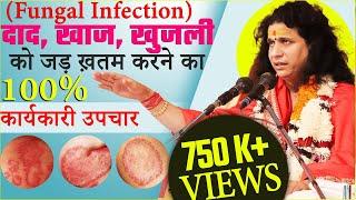 दाद खाज खुजली का 100% कार्यकारी उपचार  Fungal Infection Home Remedies