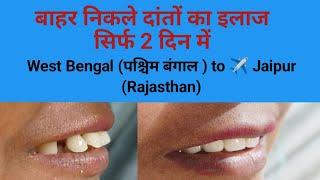 बाहर निकले दांतों का इलाज सिर्फ 2 दिन में  West Bengal to jaipur for smile makeover Smile