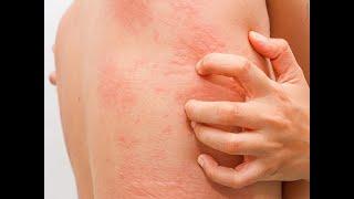 திடீரென தோலில் வரும் அரிப்பு & தடிப்பு- அர்ட்டிகேரியா Urticaria details in Tamil