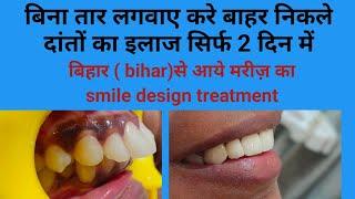 बिहारbihar State से आए मरीज़ के बाहर निकले दांतो को बिना तार लगवाए अंदरबाहर निकले दांतों का इलाज