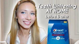 Crest 3D WHITESTRIPS Before & After - At-Home Teeth Whitening