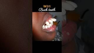 Braces for buck teeth #braces #orthodontist #dentist #dental