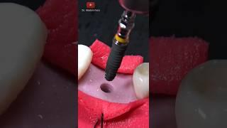 Tooth implant procedure Step by tep