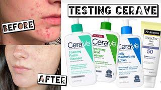 TESTING CERAVE FOR A MONTH FOR ACNE + ACNE SCARRING