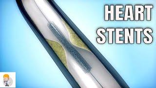 Drug-eluting stents DES Vs. Bare metal stents BMS