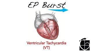 EP Burst Ventricular Tachycardia VT