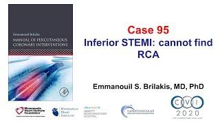 Case 95 PCI Manual - STEMI and unable to engage
