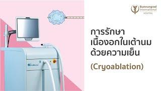 การรักษาเนื้องอกในเต้านมด้วยความเย็น Cryoablation   บำรุงราษฎร์