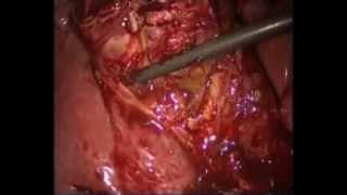 Acute cholecystitis after sleeve gastrectomy. Emergency lapchole. Unedited by Prof Yerdel