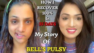 My Story Of Bell’s PulsyFacial Paralysiswhat to do & what not to do in Bell’s Pulsy चेहरे का लकवा