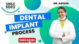 Dental Implants Restore your Smile at Smile Kochi Dental Clinic