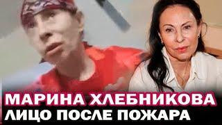 Марина Хлебникова впервые показала лицо после пожара. Как выглядит Хлебникова после пожара?