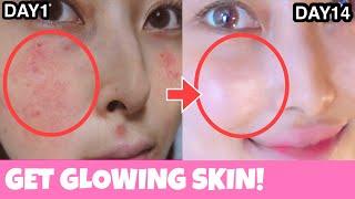 Facial Exercises For GLOWING SKIN Prevent Acne Scars Pigmentation  Anti-Aging Face Lift