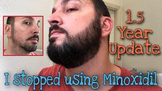 I Stopped Using Minoxidil on my Beard and 1.5 Year Update 18 Months