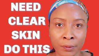 NEED CLEAR SKIN DO THIS How to clear dark spots