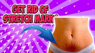 How To Get Rid Of Stretch Marks Naturally Fast – Get Rid Of Stretch Marks