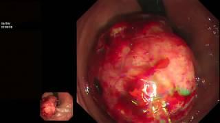 HUGE PROLAPSING RECTAL POLYP