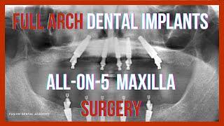 Full Arch Dental Implants All-on-5 Recorded Surgery Edentulous Patient Online Course + Free e-Book