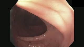 Use of a rigidizing overtube to complete an incomplete colonoscopy