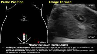Step By Step Guide On 7 Week Pregnancy Transabdominal Ultrasound Scan  Full Protocol With Reporting