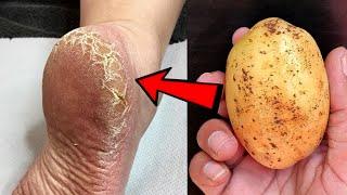 Eliminate Cracked Heels and get White and Smooth Feet  Magic Cracked Heels home remedy