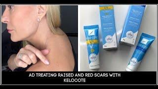 AD TREATING RAISED RED SCARS WITH KELOCOTE