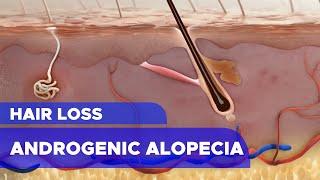 Hair Loss Androgenic Alopecia