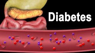 Diabetes Type 1 and Type 2 Animation.