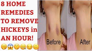 8 HOME REMEDIES TO REMOVE HICKEYS or LOVE BITES in LESS THAN AN HOUR D&N Medical Series