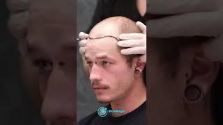 Hair Transplant Surgery  Using The Latest Technology & Techniques