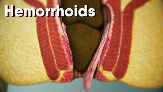 Hemorrhoidsdifferent types of hemorrhoids internal and external Hemorrhoids Hemorrhoids treatment